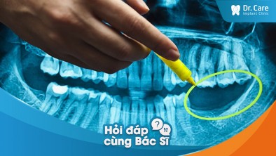 [Hỏi đáp bác sĩ] -Mất răng có ảnh hưởng đến độ cứng của xương hàm không?