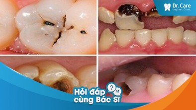 [Hỏi đáp bác sĩ] - Có phải sâu răng sẽ làm thay đổi màu sắc của răng không?