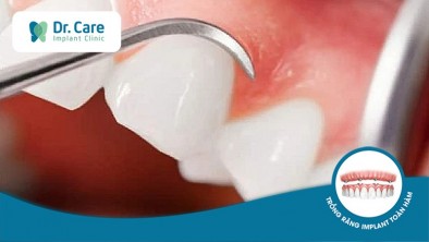 Nướu răng là gì? Cấu tạo, chức năng và các bệnh thường gặp