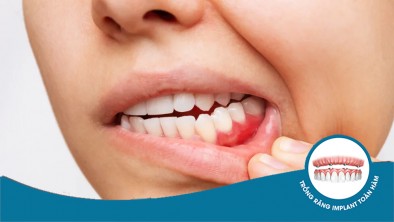 Viêm quanh cuống răng: Chẩn đoán, nguyên nhân, điều trị