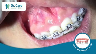 Nguyên nhân dẫn đến niềng răng bị tiêu xương? Đâu là giải pháp chữa tiêu xương hiệu quả?
