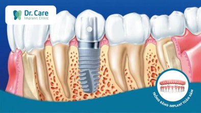 Trồng răng Implant là gì? Bảng giá, quy trình và địa điểm cấy Implant