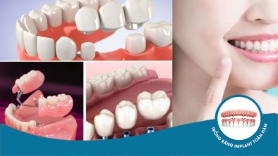 Trồng 3 răng liên tiếp: Phương pháp hiệu quả và chi phí