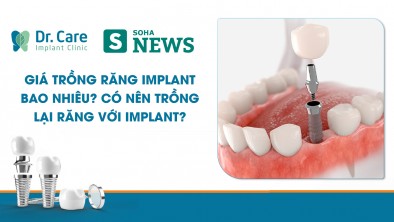 [Soha] Giá trồng răng Implant bao nhiêu? Có nên trồng lại răng với Implant?