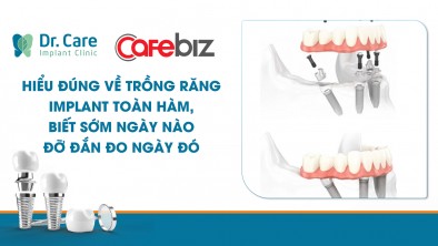 [Cafebiz] Hiểu đúng về trồng răng Implant toàn hàm, biết sớm ngày nào đỡ đắn đo ngày đó