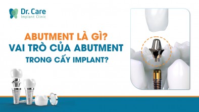 Abutment Implant là gì? Vai trò trong cấy Implant? Loại khớp nối tốt?