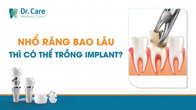 Nhổ răng bao lâu thì thích hợp trồng răng Implant? 