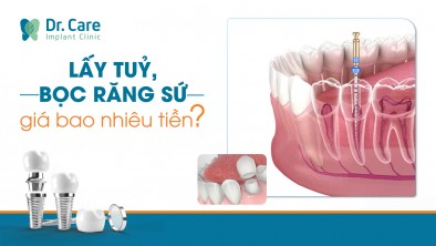 Lấy tủy bọc răng sứ giá bao nhiêu?