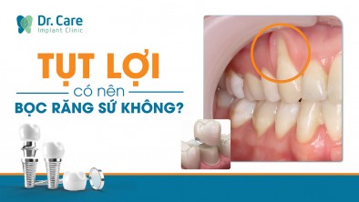 [Giải đáp] Bị tụt lợi có nên bọc răng sứ không?