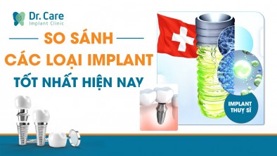 So sánh các loại implant tốt nhất hiện nay. Nên trồng răng implant loại nào?