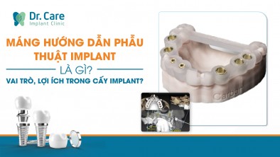 Máng hướng dẫn phẫu thuật Implant là gì? Vai trò, lợi ích trong cấy Implant?