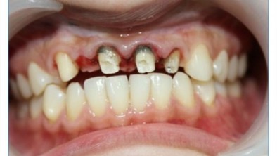 Sai lầm khi bọc răng sứ tại các nha khoa giá rẻ, không đảm bảo chất lượng