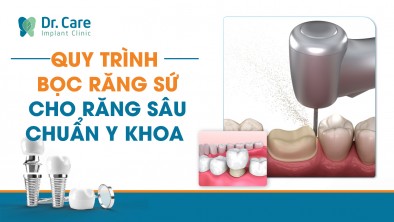 Quy trình bọc răng sứ cho răng sâu chuẩn Y khoa