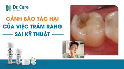Cảnh báo: 7 tác hại của việc trám răng sai kỹ thuật đối với sức khỏe răng miệng
