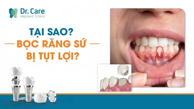 Tại sao bọc răng sứ bị tụt lợi?