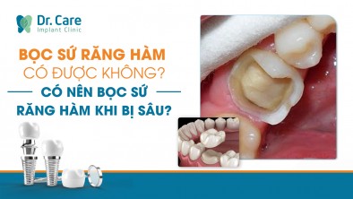 Bọc sứ răng hàm có được không? Có nên bọc sứ răng hàm khi bị sâu?