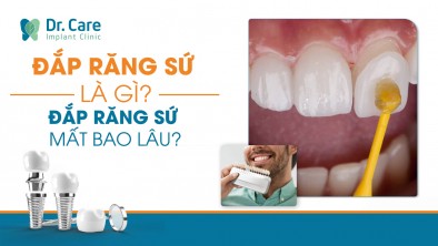 Đắp răng sứ là gì? Đắp răng sứ mất bao lâu?