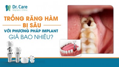 Trồng răng hàm bị sâu với phương pháp Implant giá bao nhiêu
