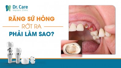 [CHI TIẾT]: Răng sứ hỏng, rớt ra phải làm sao?
