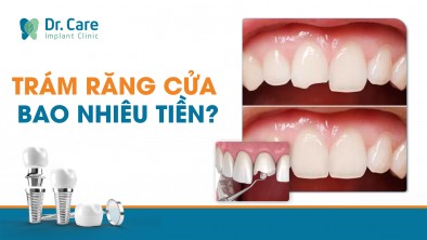 Trám răng cửa bao nhiêu tiền? 