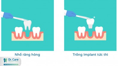 Có nên trồng răng Implant sau nhổ răng?