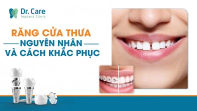 Răng cửa thưa - Nguyên nhân và cách khắc phục