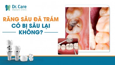 Răng đã trám rồi, có bị sâu lại không?