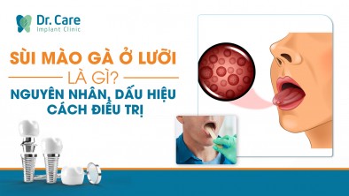 [Chi tiết] - Sùi mào gà ở lưỡi là gì? Nguyên nhân, dấu hiệu và cách điều trị