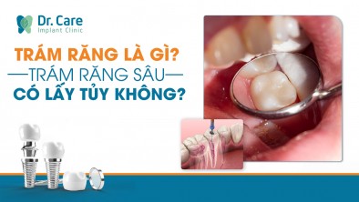 Trám răng là gì? Trám răng sâu có lấy tủy không?