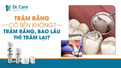 Trám răng có bền không ? Sau khi trám răng, bao lâu thì trám lại