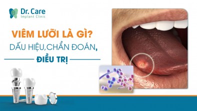 [Chi tiết] - Viêm lưỡi là gì? Dấu hiệu, chẩn đoán, điều trị và phòng ngừa viêm lưỡi