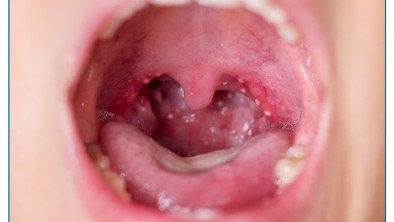 Viêm họng hạt ở lưỡi là gì? Dấu hiệu, nguyên nhân và cách điều trị