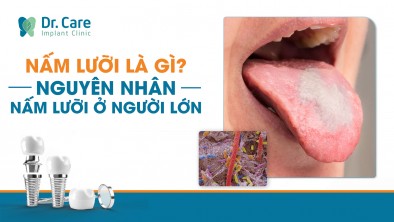 Nấm lưỡi là gì? Nguyên nhân bị nấm lưỡi ở người lớn