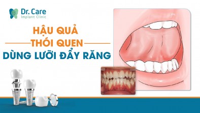 Hậu quả của thói quen dùng lưỡi đẩy răng khiến răng mọc lệch