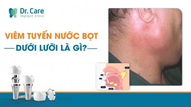 [CHI TIẾT] - VIÊM TUYẾN NƯỚC BỌT DƯỚI LƯỠI LÀ GÌ?