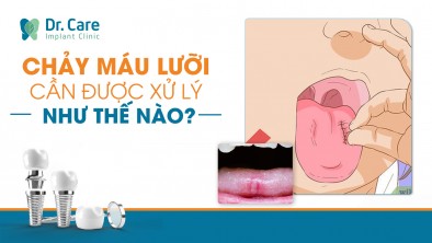 [CHI TIẾT] - Chảy máu lưỡi cần được xử lý như thế nào?