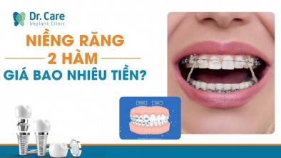 [CHI TIẾT] - Niềng răng 2 hàm bao nhiêu tiền?