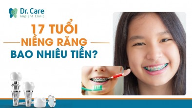 17 tuổi niềng răng bao nhiêu tiền? Có nên niềng răng lúc 17 tuổi không?