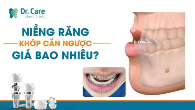 [CHI TIẾT] - NIỀNG RĂNG KHỚP CẮN NGƯỢC GIÁ BAO NHIÊU?