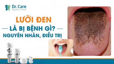 Lưỡi bị đen là bệnh gì? Dấu hiệu, nguyên nhân và cách điều trị