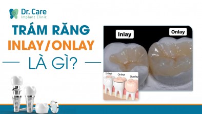 Trám răng Inlay/onlay là gì? Phục hình răng vỡ bằng phương pháp Inlay/ Onlay