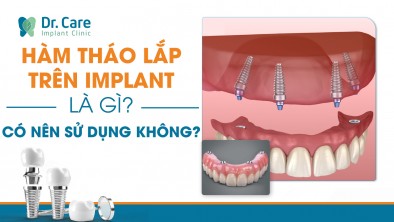 Hàm tháo lắp trên Implant là gì? Có nên sử dụng không?