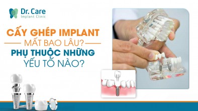 Cấy ghép Implant mất bao lâu? Phụ thuộc những yếu tố nào?