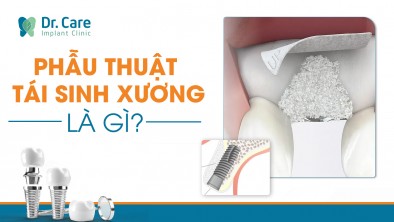 Phẫu thuật tái sinh xương (GBR) là gì? Trường hợp nào cần thực hiện phẫu thuật tái sinh xương?