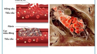 [CHI TIẾT] - RỐI LOẠN ĐÔNG MÁU LÀ GÌ? RỐI LOẠN ĐÔNG MÁU CÓ CẤY GHÉP IMPLANT ĐƯỢC KHÔNG?