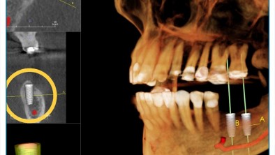 [CHI TIẾT] - Chụp phim Cone Beam CT là gì? Những lưu ý khi chụp phim Cone Beam CT