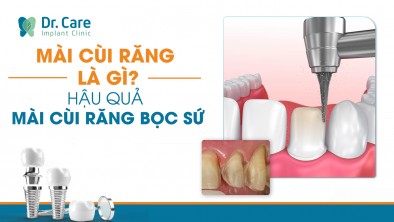 Mài cùi răng là gì? Hậu quả của việc mài cùi răng bọc sứ