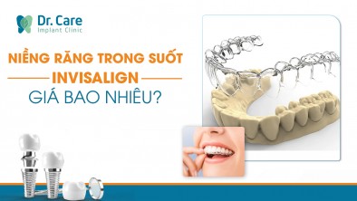 Niềng răng trong suốt Invisalign giá bao nhiêu và những điều cần biết