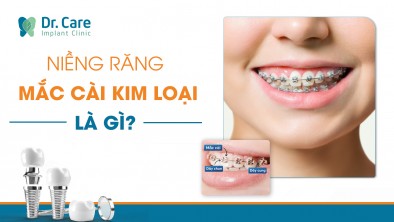 Niềng răng mắc cài kim loại là gì? Có tốt hơn mắc cài sứ không?