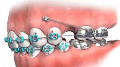 Tại sao cần phải thực hiện cắm vít khi niềng răng?